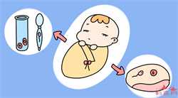 剖腹产宝宝吸羊水导致肺炎医院没及时告知是否要负责任